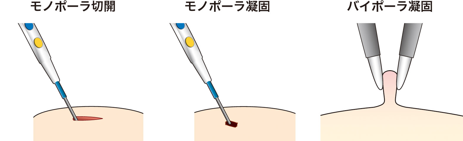 Electrosurgical Unit SHAPPER mini | SENKO MEDICAL INSTRUMENT Mfg. CO., LTD.